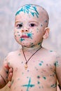 Free Chicken Pox Stock Photos - 5863343