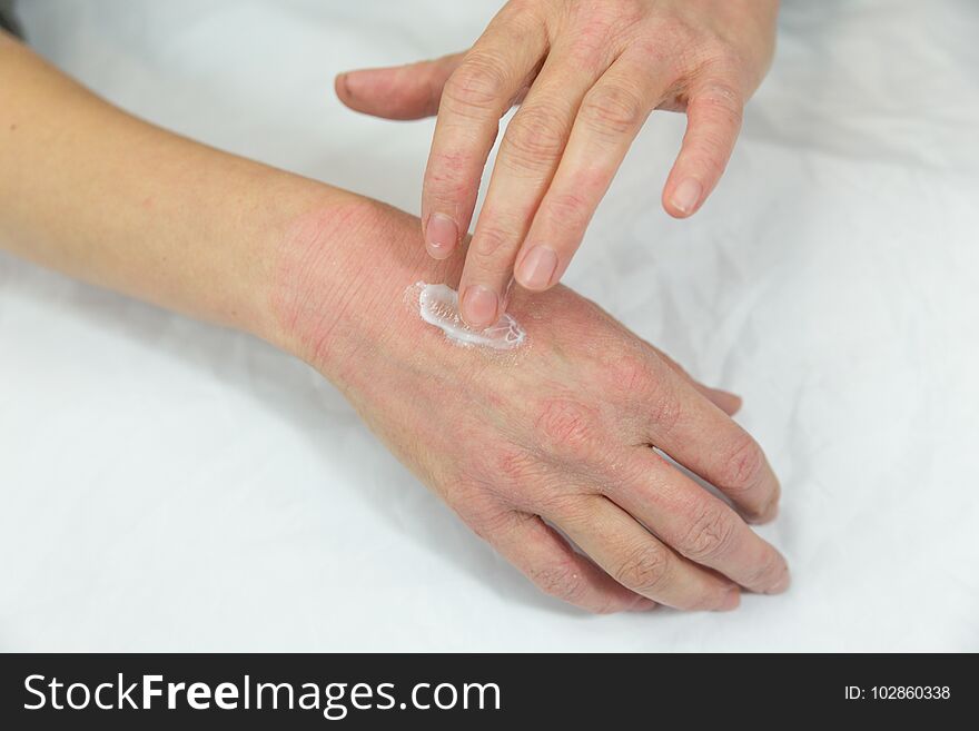 Hands Of Woman With Skin Problems