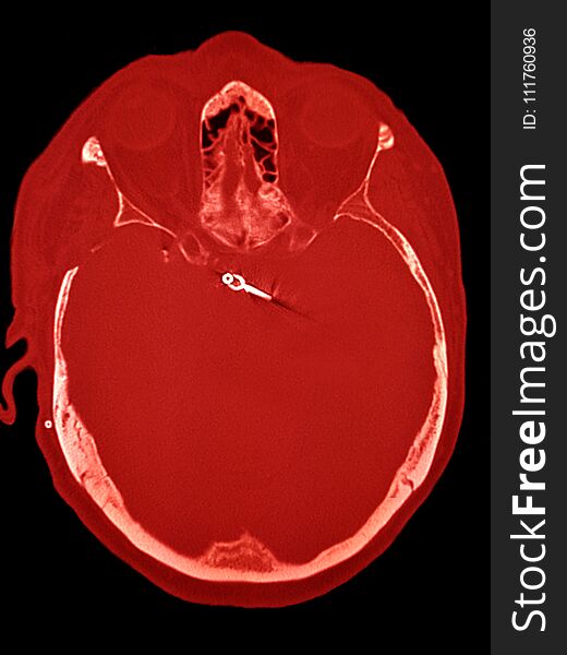 Clipsed cerebral aneurysm, illustration, CT, colored in red