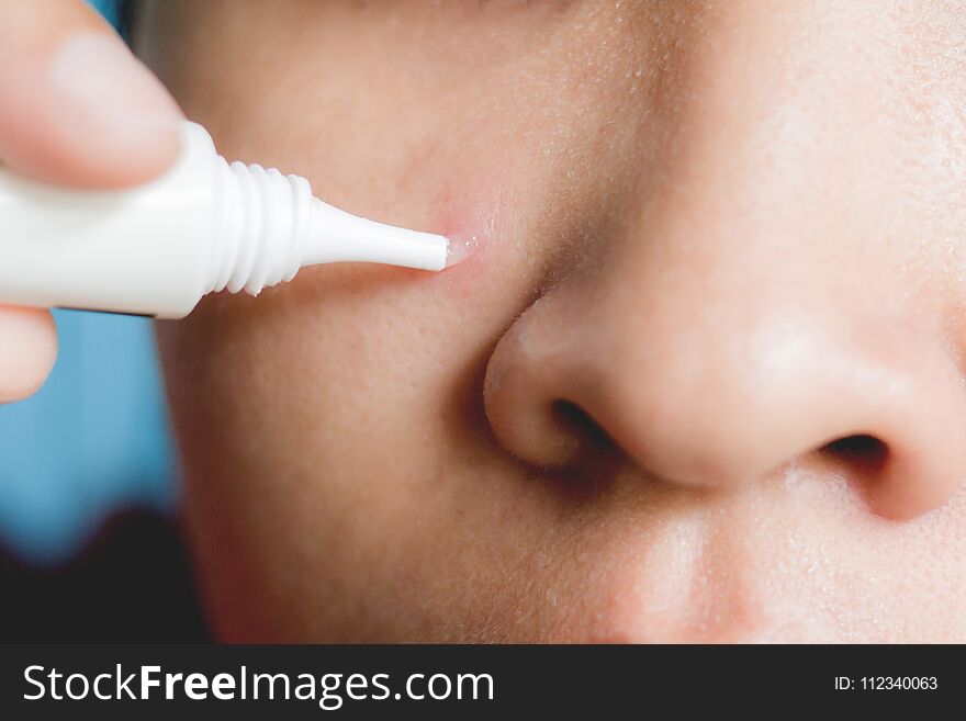 Close Up Of The Woman Heal Acne By Using A Squeeze Tube Smear Directly On The Acne.