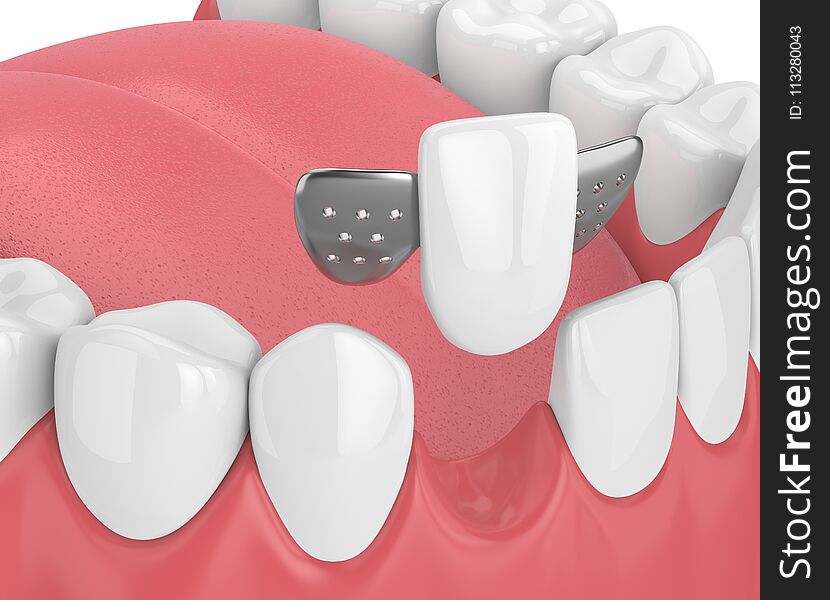 3d Render Of Jaw With Teeth And Maryland Bridge