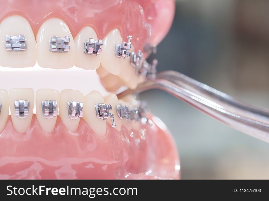 Orthodontic Model.