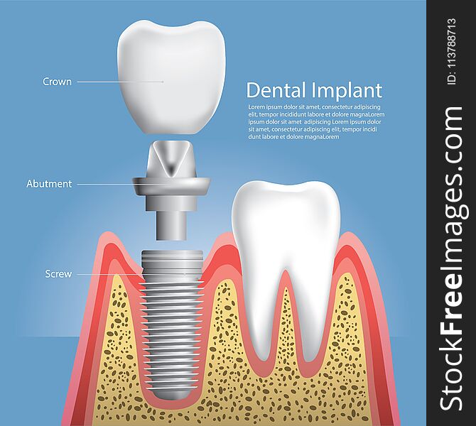 Human Teeth And Dental Implant