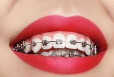 Beautiful Macro Shot Of White Teeth With Braces. Dental Care Photo. Beauty Woman Smile With Ortodontic Accessories Stock Images