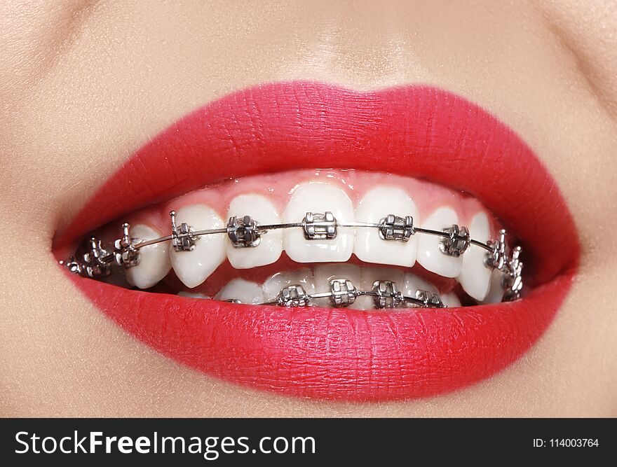 Beautiful Macro Shot Of White Teeth With Braces. Dental Care Photo. Beauty Woman Smile With Ortodontic Accessories