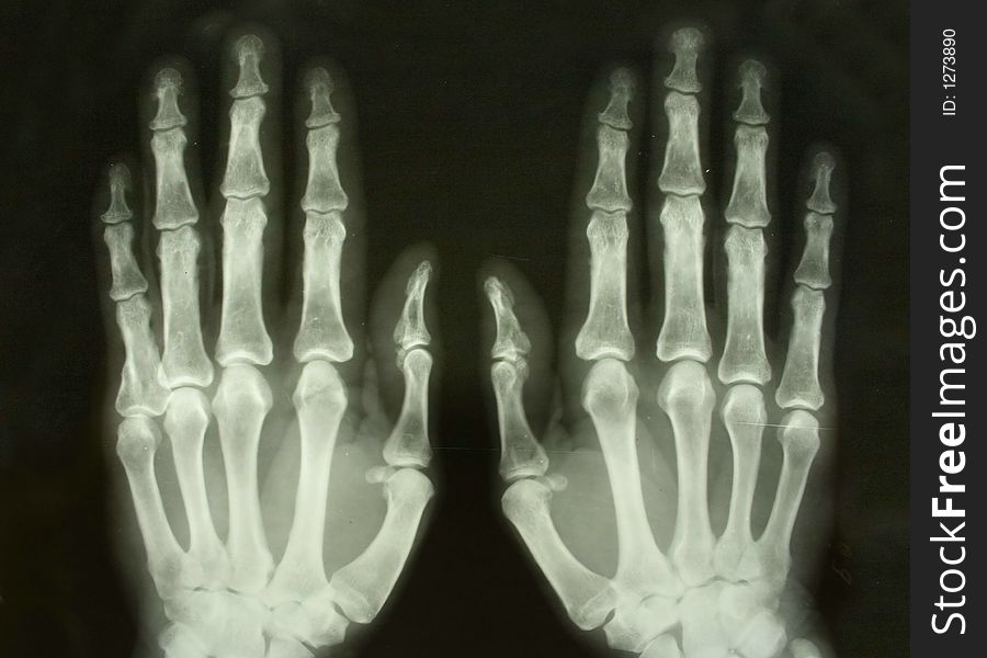 X-ray picture of the palms