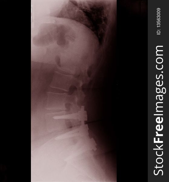 Photo of an x-ray of a spine with three screws on the pelvis. Photo of an x-ray of a spine with three screws on the pelvis