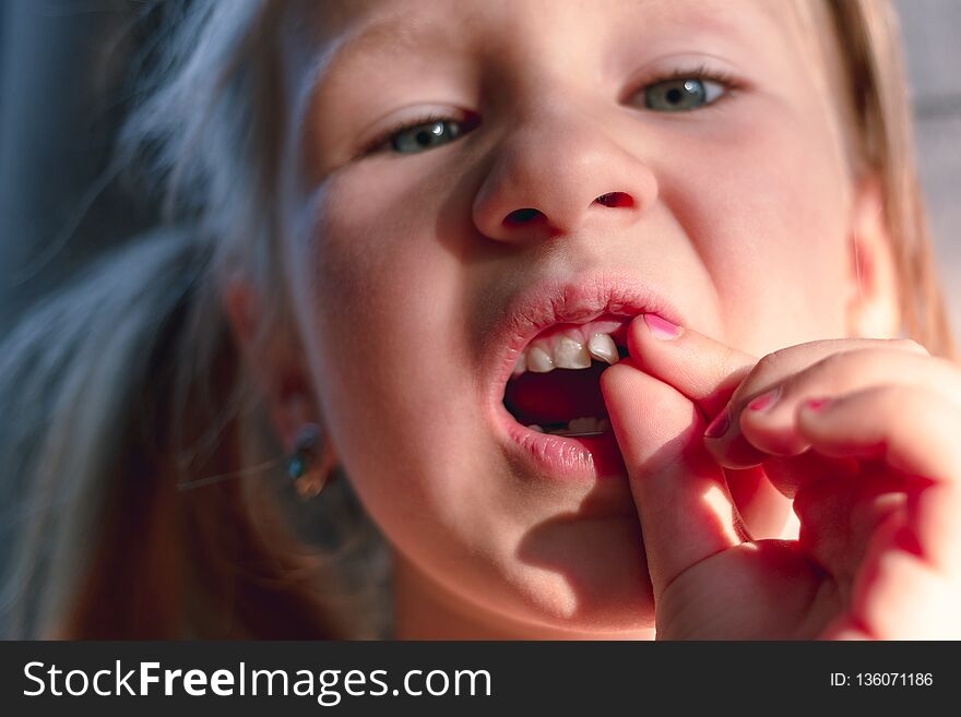 A little girl shows a wobbly baby tooth in her mouth