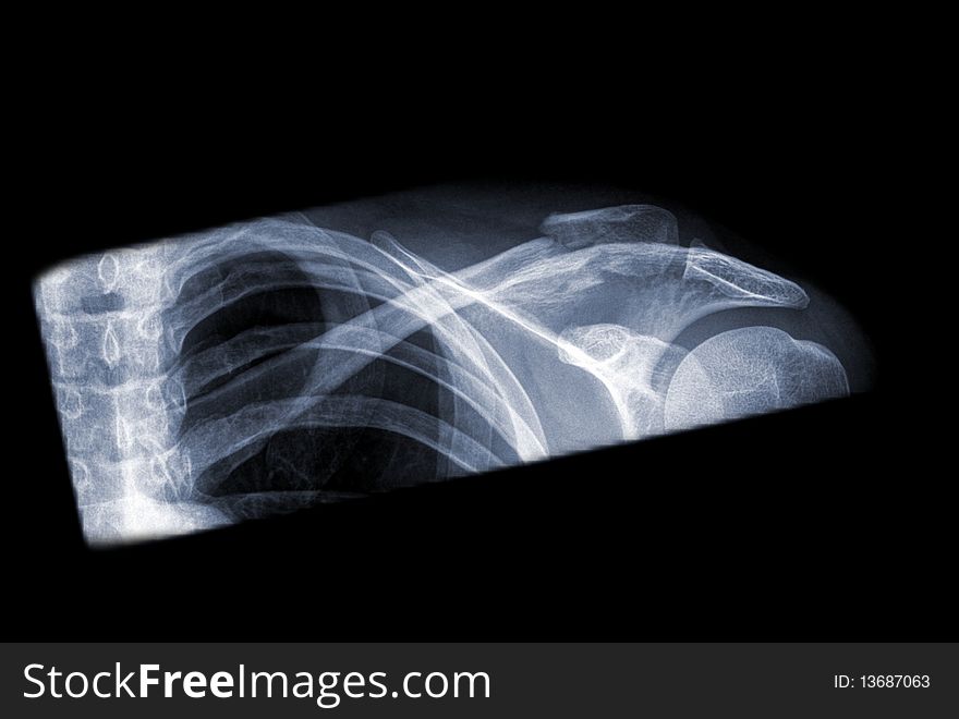 X-ray of a human clavicle ob black background