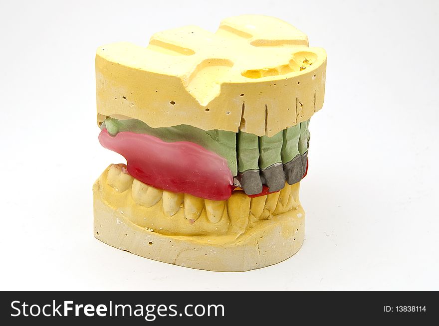 Phases of processing of a dental bridge