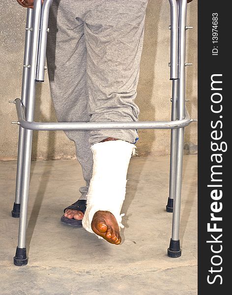 A patient is walking with plastered feet. He is walking with pipe stand/walker. A patient is walking with plastered feet. He is walking with pipe stand/walker.