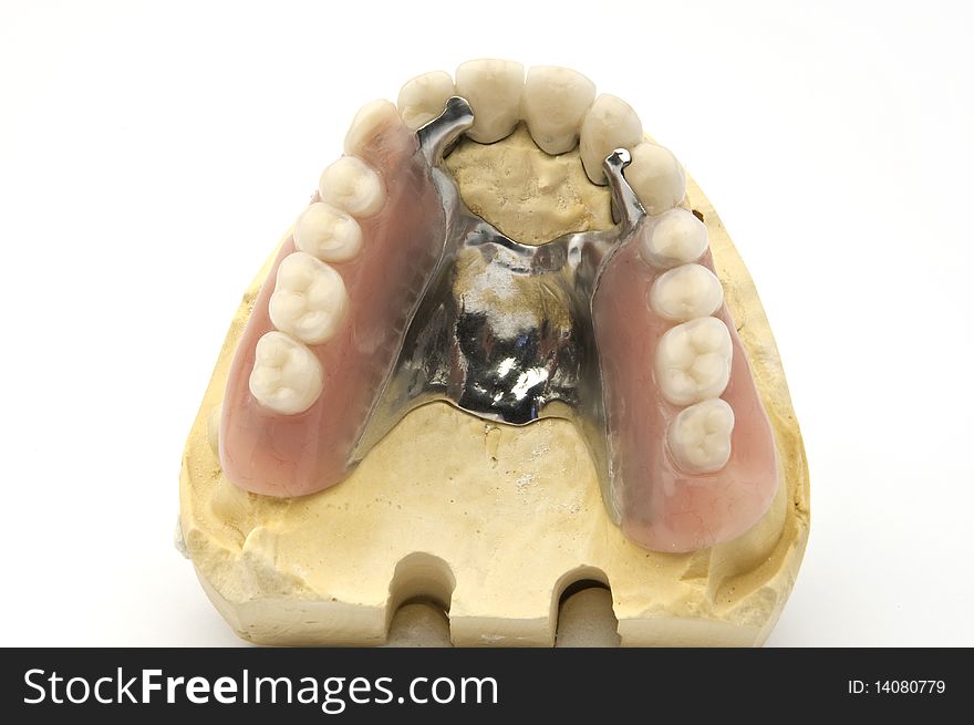 Fixed and mobil combined prosthesis on gypsum model. Fixed and mobil combined prosthesis on gypsum model