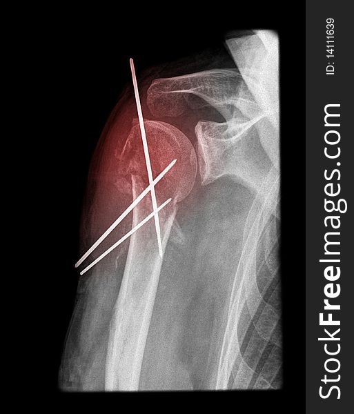 Painful shoulder surgery in an old woman isolated on black background on x-ray