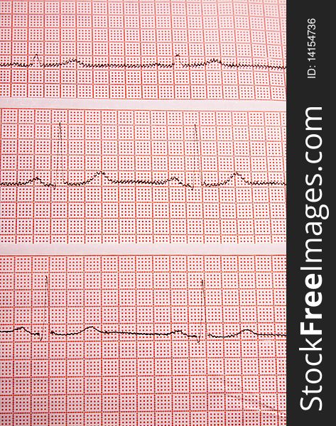 Heart rate on medical print out