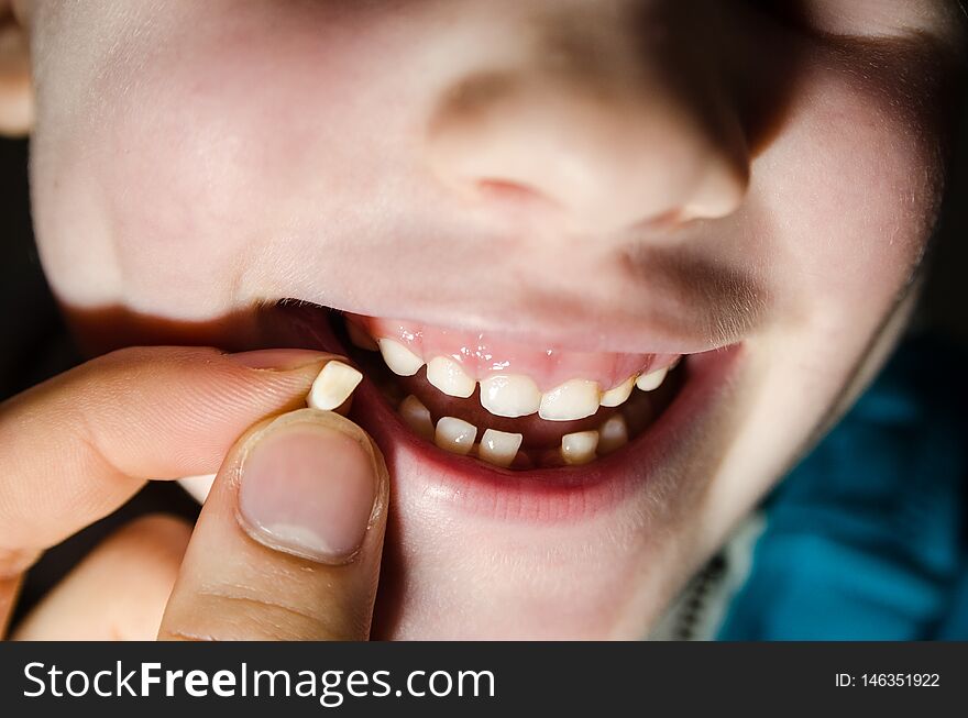 Child opening his mouth with a fallen tooth. Boy smilling in dentistry concept.