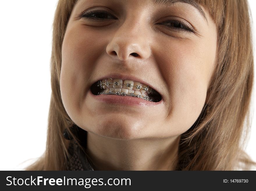 Girl Smiles With Bracket On Teeth