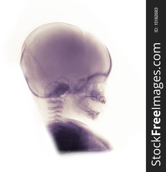 X-ray of a 3 month old female showing the normal anatomy of the skull and neck.