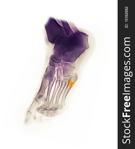 Foot x-ray of a 61 year old man showing a fracture of the 5th metatarsal. Foot x-ray of a 61 year old man showing a fracture of the 5th metatarsal