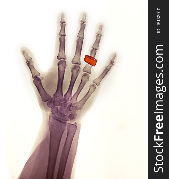 Normal hand x-ray of a 55 year old female wearing a wedding ring. Normal hand x-ray of a 55 year old female wearing a wedding ring