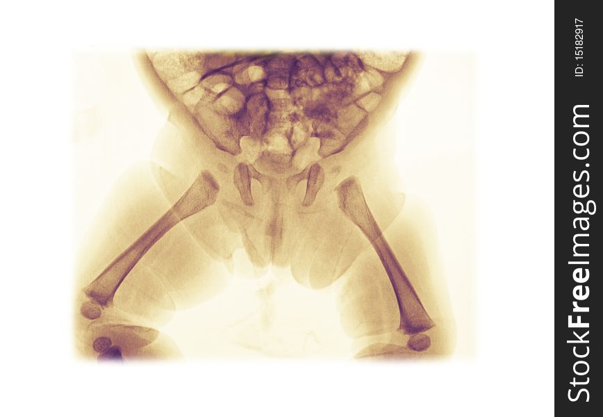 Pelvis x-ray of a 3 month old girl showing normal anatomy of the developing bones. Pelvis x-ray of a 3 month old girl showing normal anatomy of the developing bones