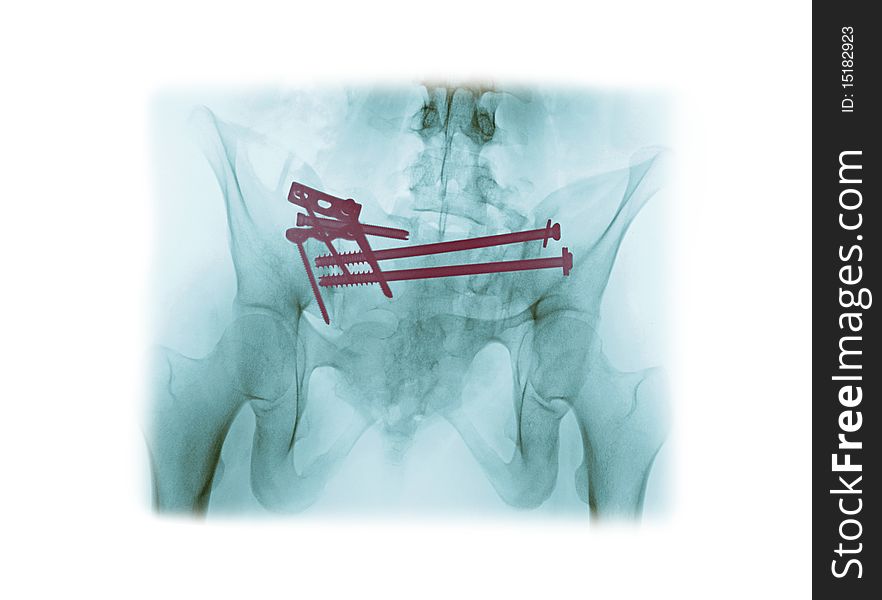 X-ray of the pelvis of a 21 year old woman who required surgical repair of a pelvis fracture from a car accident. This patient was not wearing a seat belt. X-ray of the pelvis of a 21 year old woman who required surgical repair of a pelvis fracture from a car accident. This patient was not wearing a seat belt.