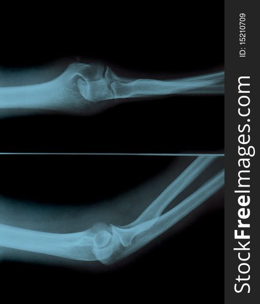 Roentgen a picture of a sick human hand