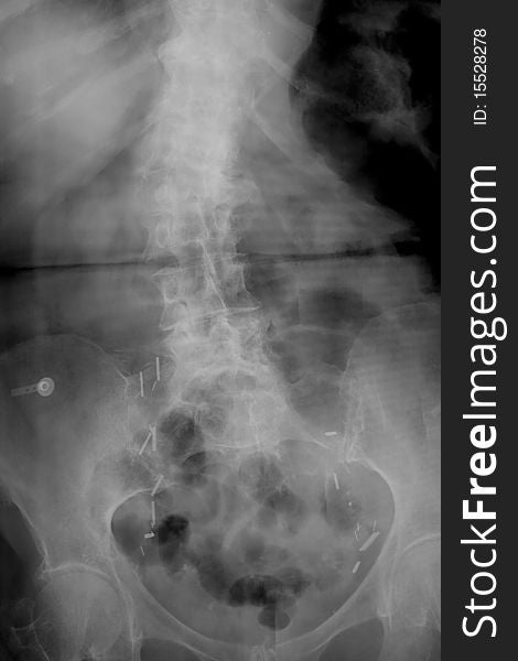 Lumbar spine with scoliosis, pins, clips, and from previous surgery. Lumbar spine with scoliosis, pins, clips, and from previous surgery