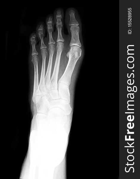 Anterior posterior xray of foot. Anterior posterior xray of foot