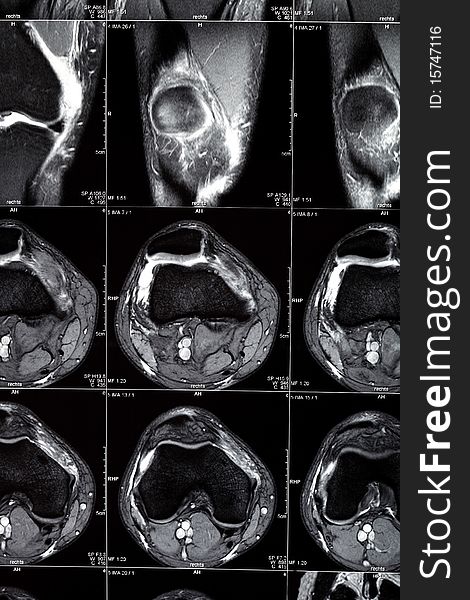 MRT Scan