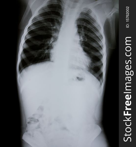 Detail of x-ray image : Chest x-ray of young boy