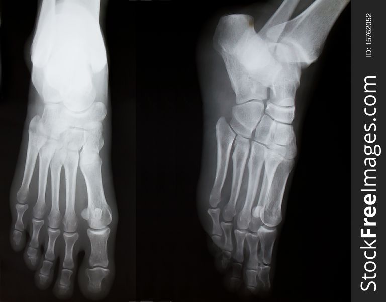 X-ray of both human feet. 
No fracture.
