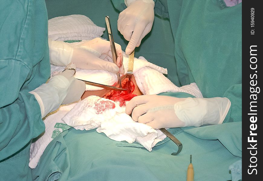 Cesarean Operation