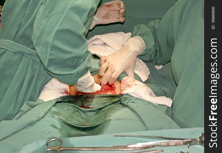 Caesarean operation