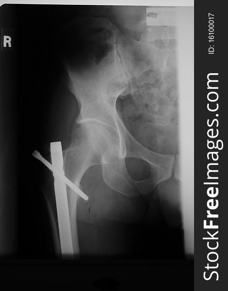 This is a photo of a right hip x-ray.