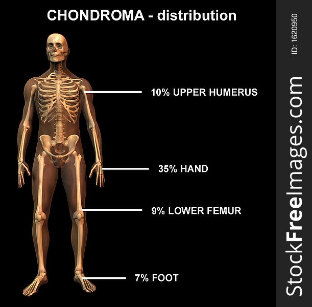 Illustration to show distribution of chondroma in the human body