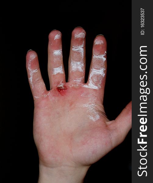Chalked weightlifter's hand with a torn callous. Chalked weightlifter's hand with a torn callous