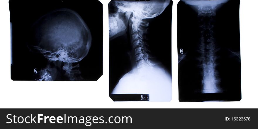 X-Ray film of neck and head - three views - front and side. X-Ray film of neck and head - three views - front and side