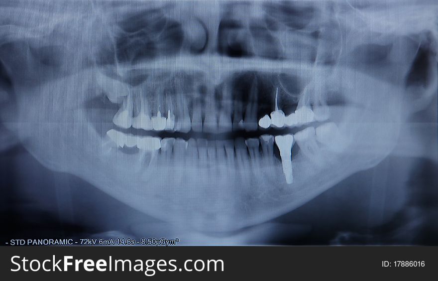 X-ray of the jaw close up. X-ray of the jaw close up