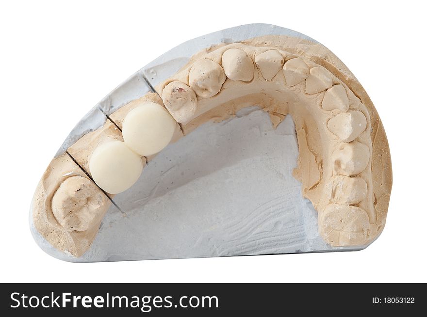 Dental Prosthesis