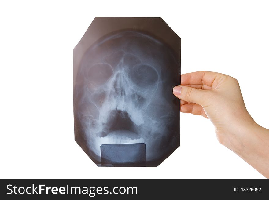 X-ray Picture Of A Head In A Hand
