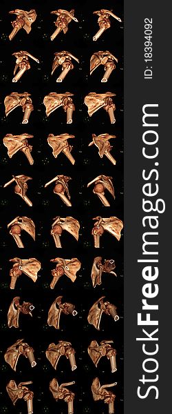 Three-dimensional reconstruction of a computed tomogramm of the shoulder joint showing a fracture of humeral bone. Three-dimensional reconstruction of a computed tomogramm of the shoulder joint showing a fracture of humeral bone