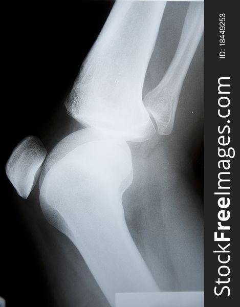 X-ray pathology human knee