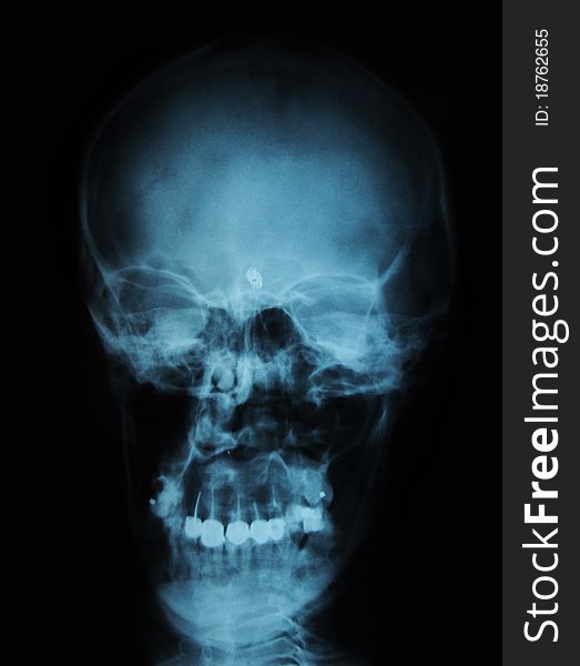 X-ray/ rtg of human head (black background). X-ray/ rtg of human head (black background)