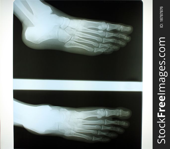 An x-ray of a human foot. An x-ray of a human foot