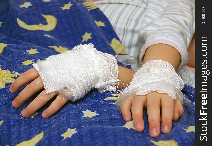 Young girl illness, 
bandage, foil, ointment on the hands, 
burns and scalds hands or allergic hands,