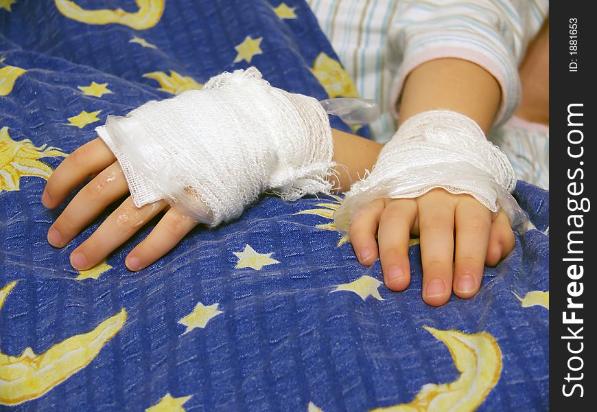 Young girl illness, 
bandage, foil, ointment on the hands, 
burns and scalds hands or allergic hands,