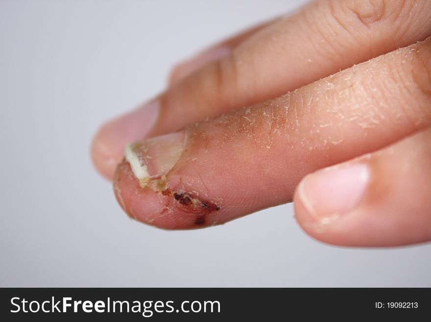 Left Finger Cut