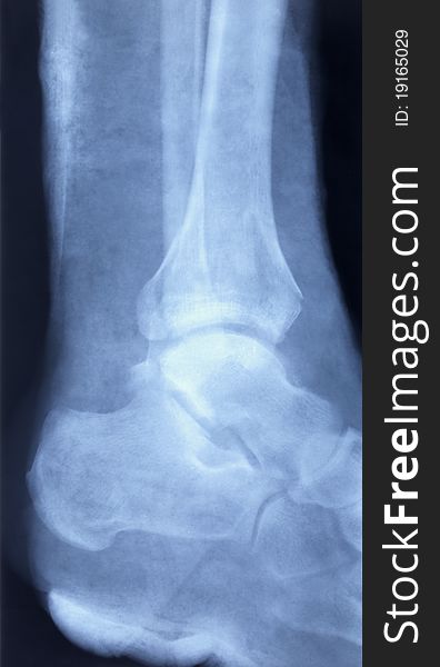 Old x-ray image of human foot