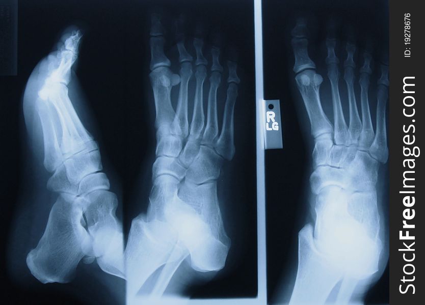 Digital image of an x-ray of a rt foot showing three views. Digital image of an x-ray of a rt foot showing three views.