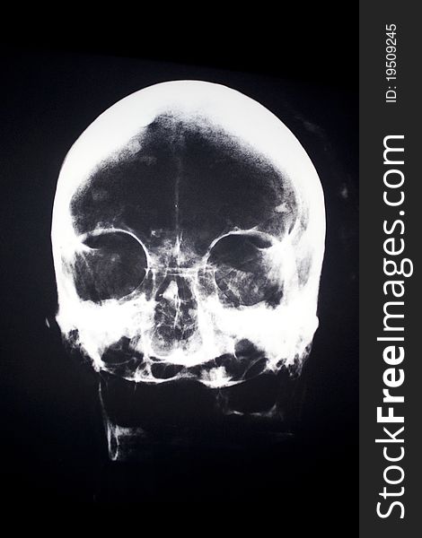 X-Ray of a human head.